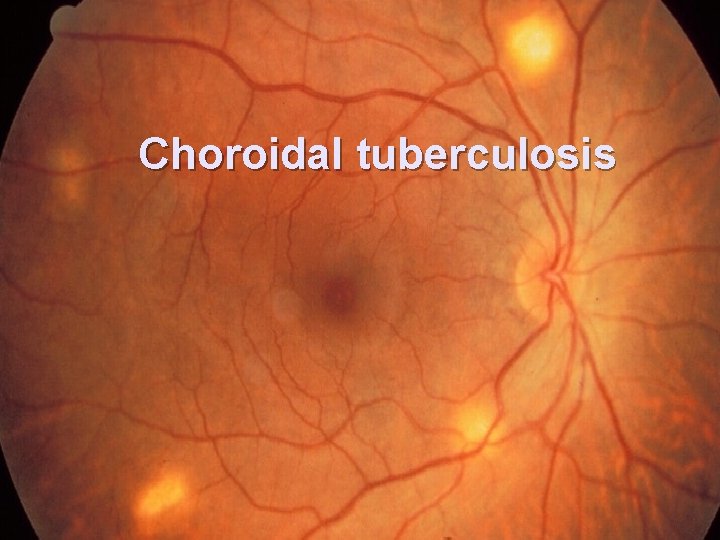 Choroidal tuberculosis 