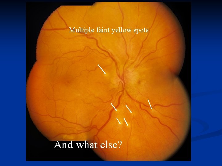 Multiple faint yellow spots And what else? 