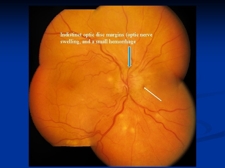 Indistinct optic disc margins (optic nerve swelling, and a small hemorrhage 
