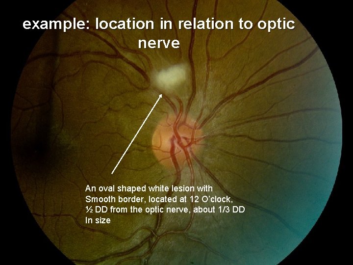 example: location in relation to optic nerve An oval shaped white lesion with Smooth