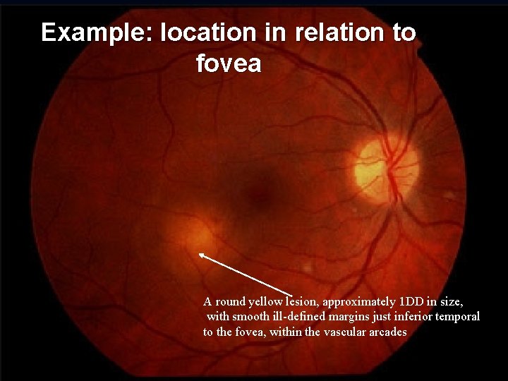 Example: location in relation to fovea A round yellow lesion, approximately 1 DD in