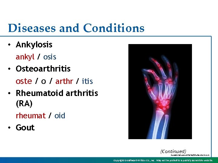 Diseases and Conditions • Ankylosis ankyl / osis • Osteoarthritis oste / o /