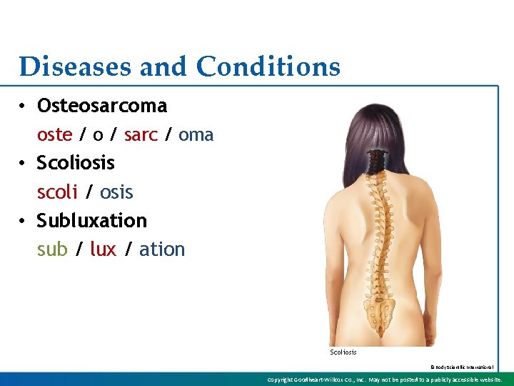 Diseases and Conditions • Osteosarcoma oste / o / sarc / oma • Scoliosis