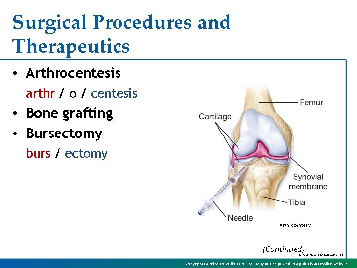 Surgical Procedures and Therapeutics • Arthrocentesis arthr / o / centesis • Bone grafting