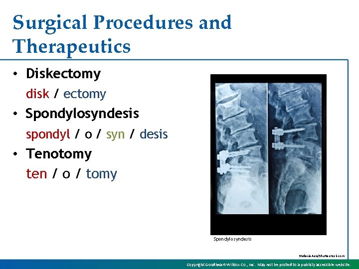 Surgical Procedures and Therapeutics • Diskectomy disk / ectomy • Spondylosyndesis spondyl / o