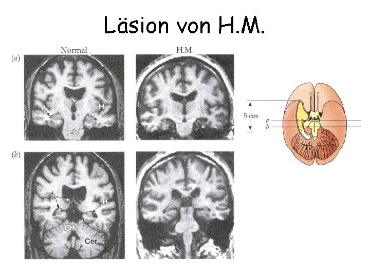 Läsion von H. M. 