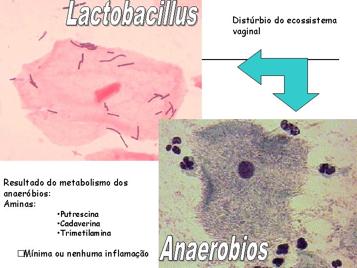 Distúrbio do ecossistema vaginal Resultado do metabolismo dos anaeróbios: Aminas: • Putrescina • Cadaverina