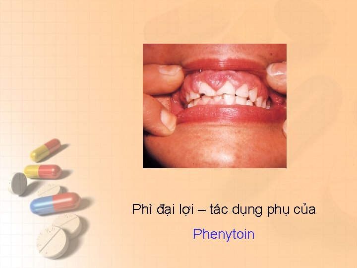 Phì đại lợi – tác dụng phụ của Phenytoin 