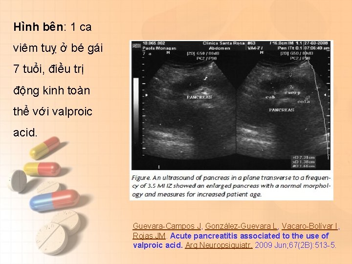 Hình bên: 1 ca viêm tuỵ ở bé gái 7 tuổi, điều trị động