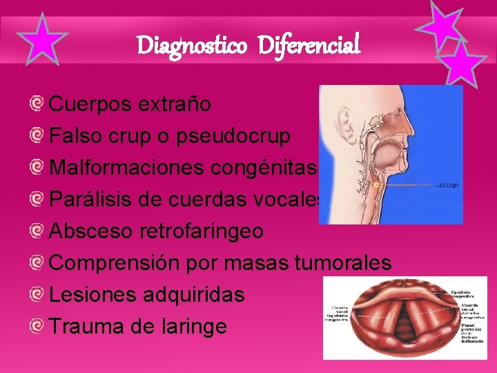 Diagnostico Diferencial Cuerpos extraño Falso crup o pseudocrup Malformaciones congénitas Parálisis de cuerdas vocales