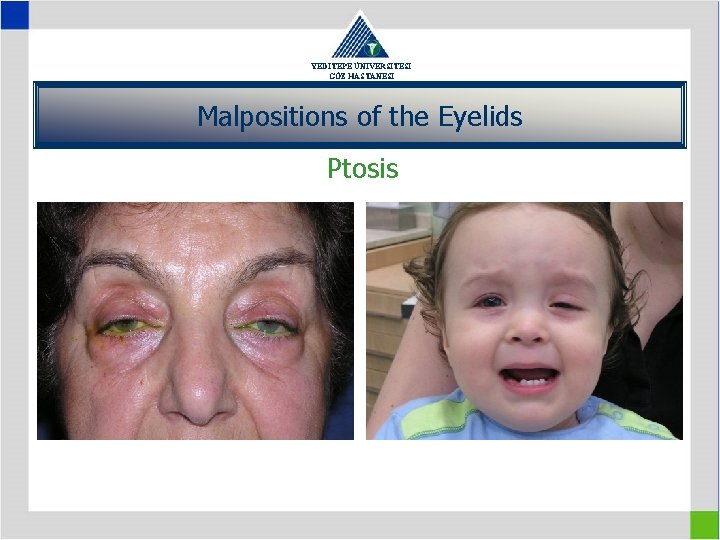 YEDİTEPE ÜNİVERSİTESİ GÖZ HASTANESİ Malpositions of the Eyelids Ptosis 