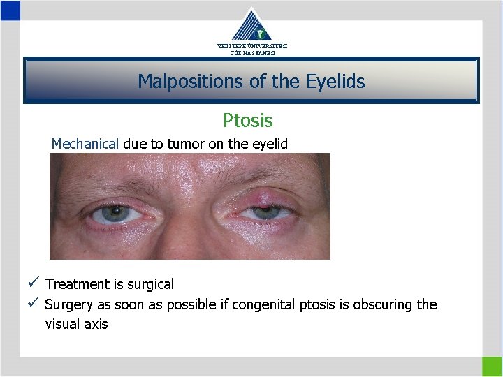 YEDİTEPE ÜNİVERSİTESİ GÖZ HASTANESİ Malpositions of the Eyelids Ptosis Mechanical due to tumor on