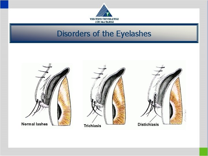 YEDİTEPE ÜNİVERSİTESİ GÖZ HASTANESİ Disorders of the Eyelashes 