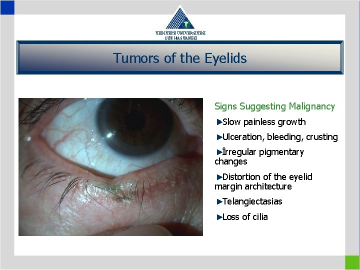 YEDİTEPE ÜNİVERSİTESİ GÖZ HASTANESİ Tumors of the Eyelids Signs Suggesting Malignancy Slow painless growth