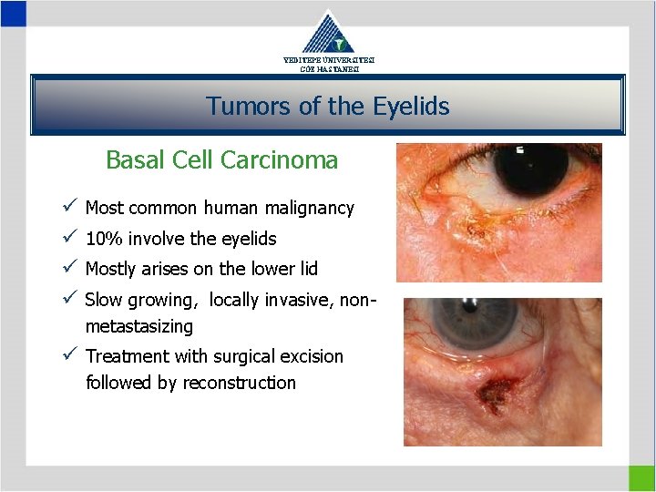 YEDİTEPE ÜNİVERSİTESİ GÖZ HASTANESİ Tumors of the Eyelids Basal Cell Carcinoma ü ü Most