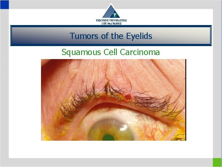 YEDİTEPE ÜNİVERSİTESİ GÖZ HASTANESİ Tumors of the Eyelids Squamous Cell Carcinoma 