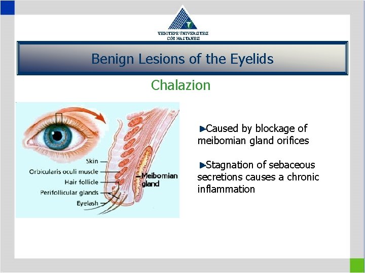 YEDİTEPE ÜNİVERSİTESİ GÖZ HASTANESİ Benign Lesions of the Eyelids Chalazion Caused by blockage of
