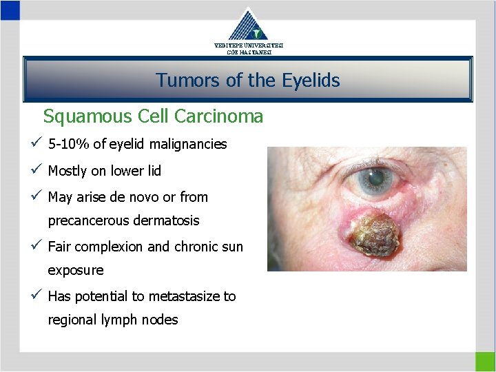 YEDİTEPE ÜNİVERSİTESİ GÖZ HASTANESİ Tumors of the Eyelids Squamous Cell Carcinoma ü 5 -10%