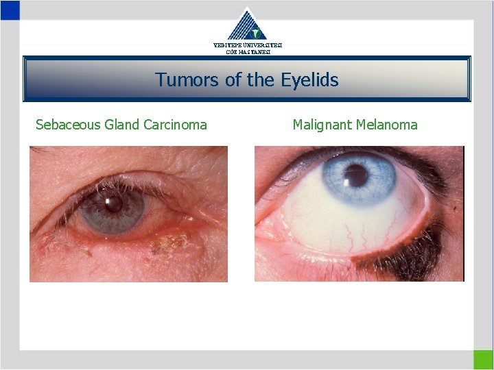 YEDİTEPE ÜNİVERSİTESİ GÖZ HASTANESİ Tumors of the Eyelids Sebaceous Gland Carcinoma Malignant Melanoma 