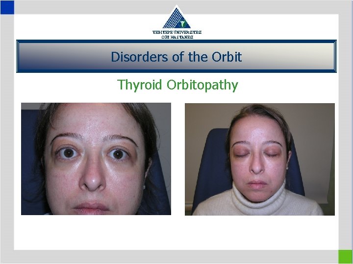 YEDİTEPE ÜNİVERSİTESİ GÖZ HASTANESİ Disorders of the Orbit Thyroid Orbitopathy 
