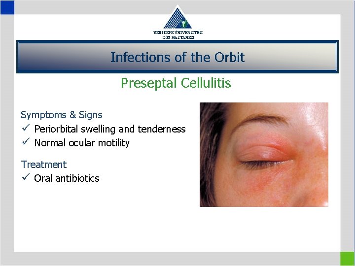 YEDİTEPE ÜNİVERSİTESİ GÖZ HASTANESİ Infections of the Orbit Preseptal Cellulitis Symptoms & Signs ü