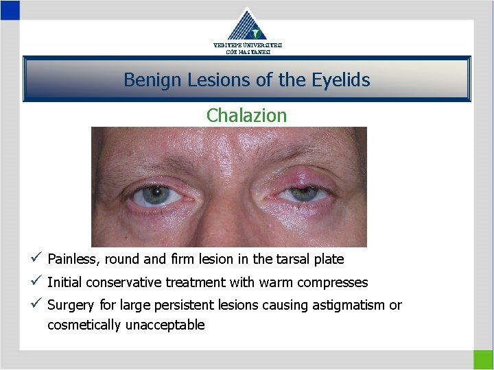 YEDİTEPE ÜNİVERSİTESİ GÖZ HASTANESİ Benign Lesions of the Eyelids Chalazion ü Painless, round and