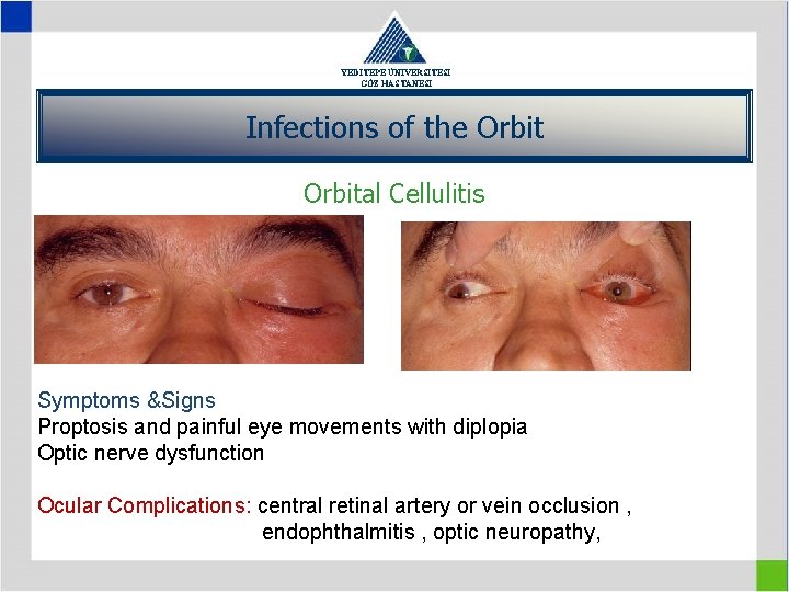 YEDİTEPE ÜNİVERSİTESİ GÖZ HASTANESİ Infections of the Orbital Cellulitis Symptoms &Signs Proptosis and painful