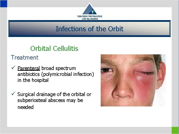 YEDİTEPE ÜNİVERSİTESİ GÖZ HASTANESİ Infections of the Orbital Cellulitis Treatment ü Parenteral broad spectrum