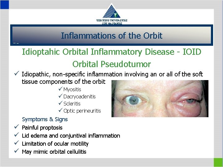 YEDİTEPE ÜNİVERSİTESİ GÖZ HASTANESİ Inflammations of the Orbit Idioptahic Orbital Inflammatory Disease - IOID