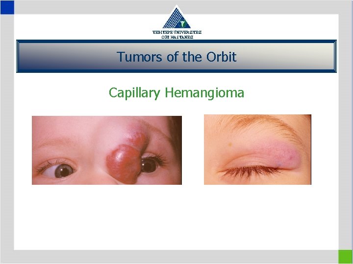 YEDİTEPE ÜNİVERSİTESİ GÖZ HASTANESİ Tumors of the Orbit Capillary Hemangioma 