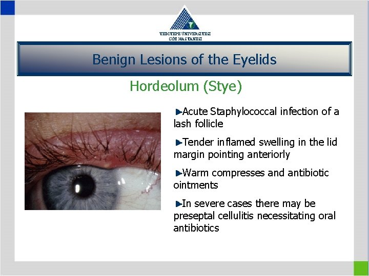 YEDİTEPE ÜNİVERSİTESİ GÖZ HASTANESİ Benign Lesions of the Eyelids Hordeolum (Stye) Acute Staphylococcal infection