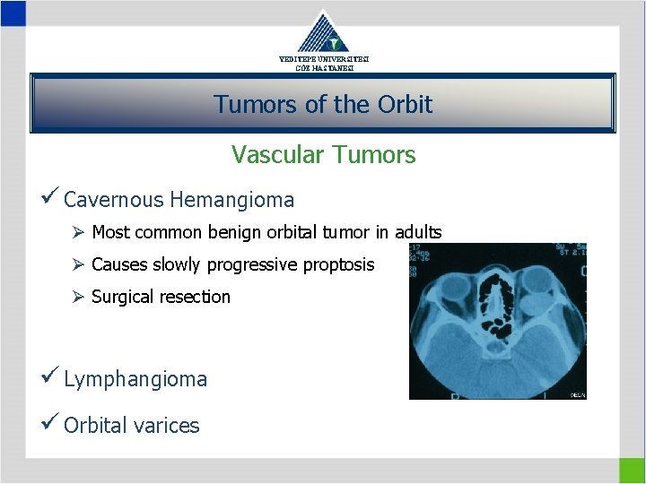 YEDİTEPE ÜNİVERSİTESİ GÖZ HASTANESİ Tumors of the Orbit Vascular Tumors ü Cavernous Hemangioma Ø