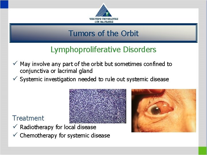 YEDİTEPE ÜNİVERSİTESİ GÖZ HASTANESİ Tumors of the Orbit Lymphoproliferative Disorders ü May involve any