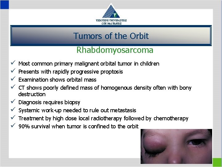 YEDİTEPE ÜNİVERSİTESİ GÖZ HASTANESİ Tumors of the Orbit Rhabdomyosarcoma ü ü ü ü Most