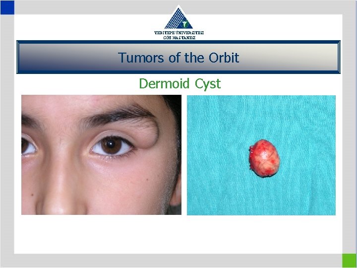 YEDİTEPE ÜNİVERSİTESİ GÖZ HASTANESİ Tumors of the Orbit Dermoid Cyst 