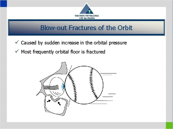 YEDİTEPE ÜNİVERSİTESİ GÖZ HASTANESİ Blow-out Fractures of the Orbit ü Caused by sudden increase