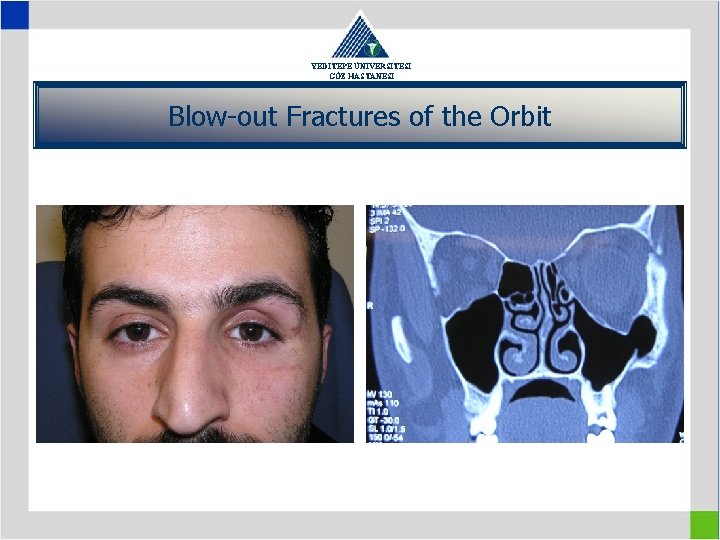 YEDİTEPE ÜNİVERSİTESİ GÖZ HASTANESİ Blow-out Fractures of the Orbit 