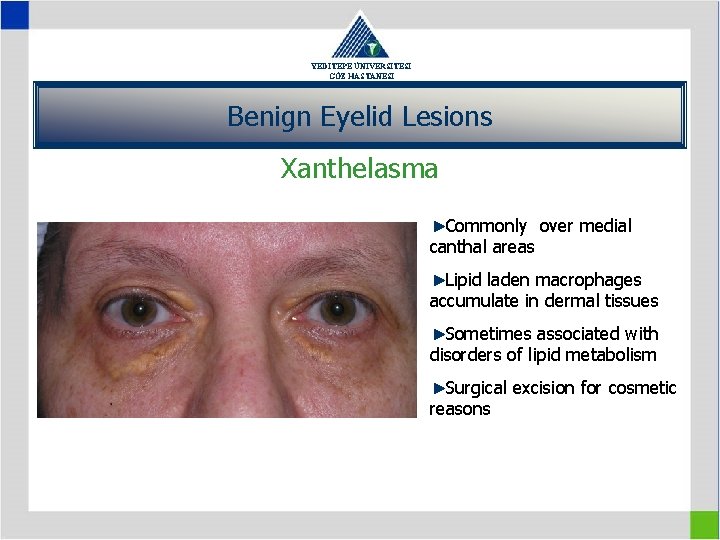 YEDİTEPE ÜNİVERSİTESİ GÖZ HASTANESİ Benign Eyelid Lesions Xanthelasma Commonly over medial canthal areas Lipid