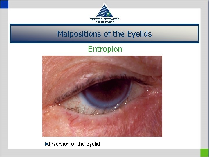 YEDİTEPE ÜNİVERSİTESİ GÖZ HASTANESİ Malpositions of the Eyelids Entropion Inversion of the eyelid 