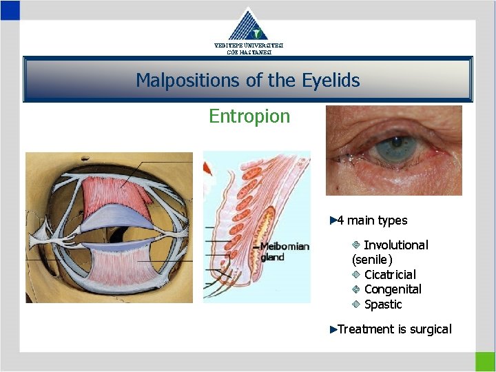 YEDİTEPE ÜNİVERSİTESİ GÖZ HASTANESİ Malpositions of the Eyelids Entropion 4 main types Involutional (senile)