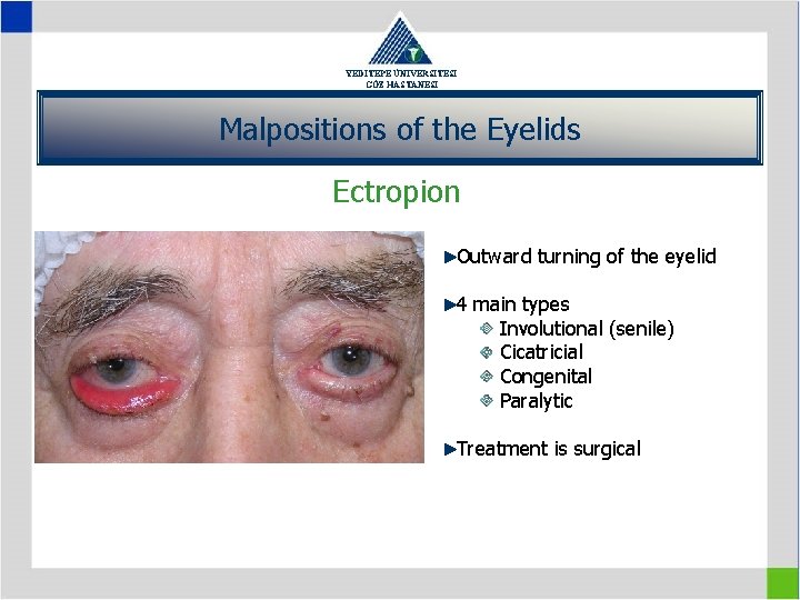 YEDİTEPE ÜNİVERSİTESİ GÖZ HASTANESİ Malpositions of the Eyelids Ectropion Outward turning of the eyelid