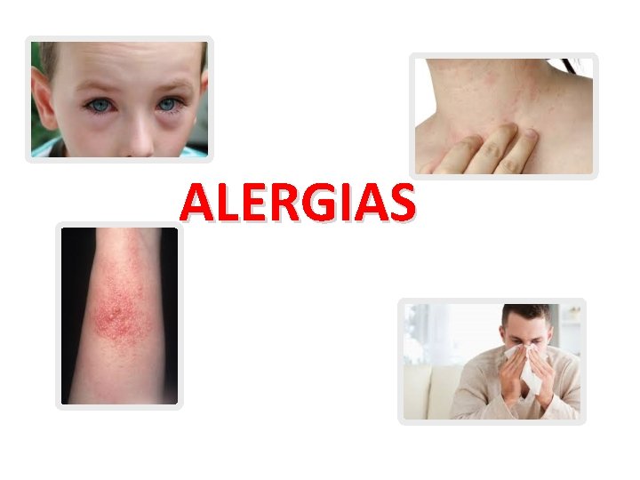 ALERGIAS 