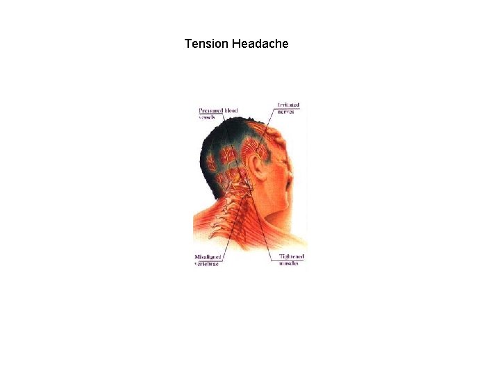 Tension Headache Tension Headache