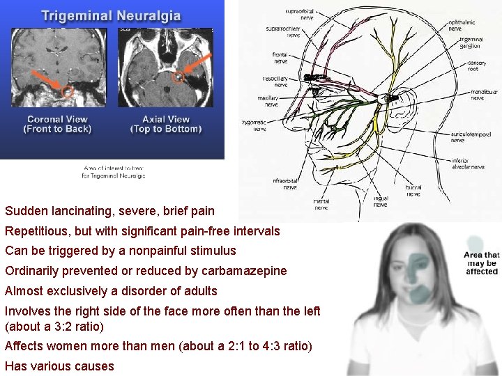Sudden lancinating, severe, brief pain Repetitious, but with significant pain-free intervals Can be triggered Sudden lancinating, severe, brief pain Repetitious, but with significant pain-free intervals Can be triggered