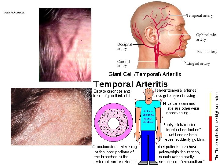 Giant Cell (Temporal) Arteritis Giant Cell (Temporal) Arteritis