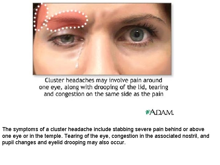 The symptoms of a cluster headache include stabbing severe pain behind or above one The symptoms of a cluster headache include stabbing severe pain behind or above one