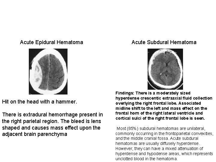 Acute Epidural Hematoma Hit on the head with a hammer. There is extradural hemorrhage Acute Epidural Hematoma Hit on the head with a hammer. There is extradural hemorrhage