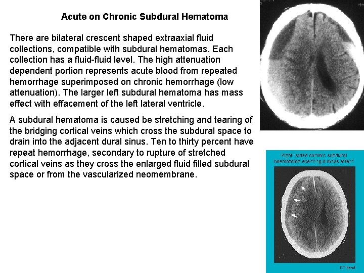 Acute on Chronic Subdural Hematoma There are bilateral crescent shaped extraaxial fluid collections, compatible Acute on Chronic Subdural Hematoma There are bilateral crescent shaped extraaxial fluid collections, compatible