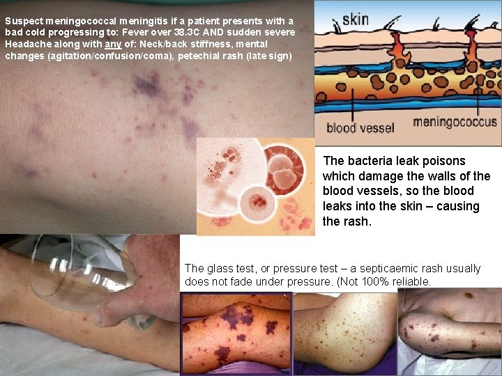 Suspect meningococcal meningitis if a patient presents with a bad cold progressing to: Fever Suspect meningococcal meningitis if a patient presents with a bad cold progressing to: Fever
