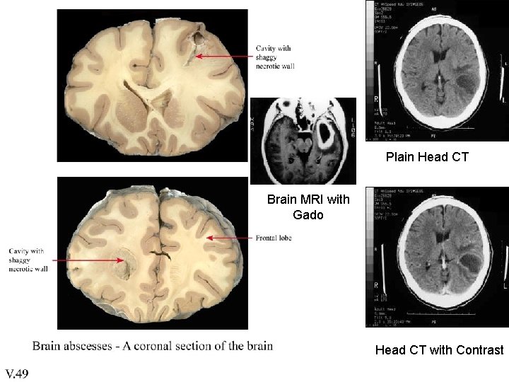 Plain Head CT Brain MRI with Gado Head CT with Contrast Plain Head CT Brain MRI with Gado Head CT with Contrast